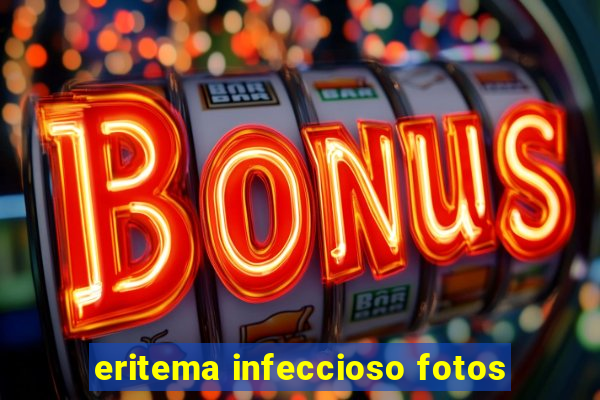 eritema infeccioso fotos